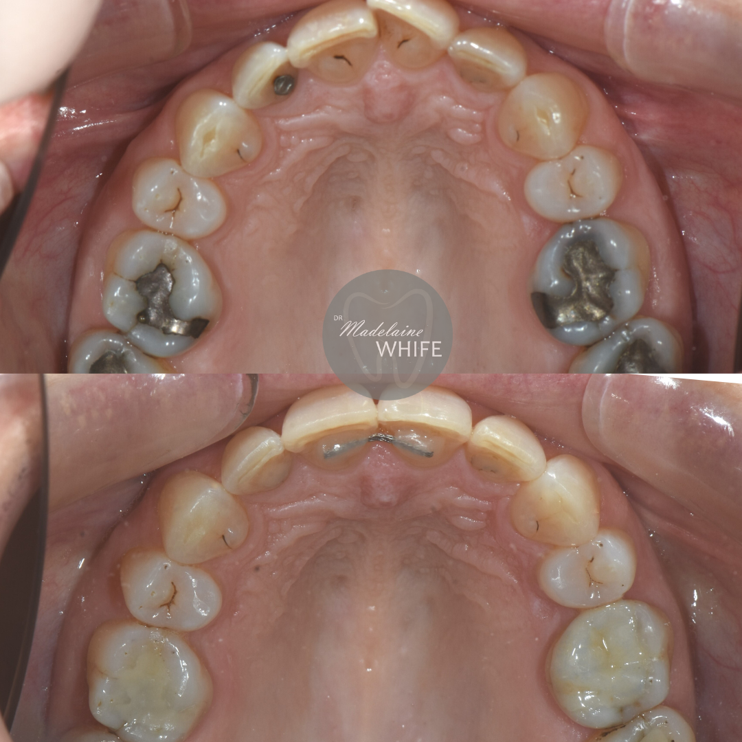 Patient 4 transformation